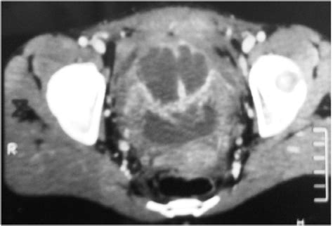 Tdm Showed Heterogeneous Pelvic Mass Download Scientific Diagram