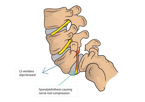 Pars Fracture Spondylolysis And Spondylolisthesis Dr Yu Chao Lee