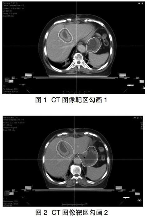 原发性肝癌患者螺旋断层放射与三维适形放射治疗剂量分布比较参考网