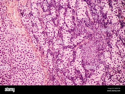 Testicular Cancer Light Micrograph Of A Section Through A Seminoma A