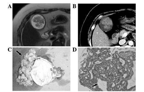 Large Benign Gallbladder Lesions A The Largest Adenoma In Our Records