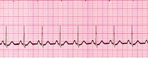 Ekg Strips Flashcards Quizlet