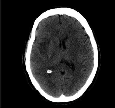 A Ct Imaging Of Preoperative Cerebral Oedema With Incipient Uncus