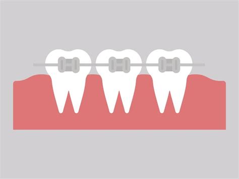 Metalen Beugels Tandheelkundige Orthodontische Tanden Met Beugels