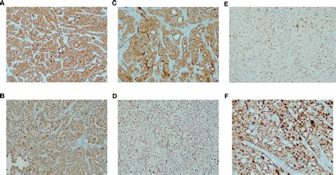 Frontiers A Case Report Of Pulmonary Hepatoid Adenocarcinoma