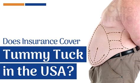 Does Insurance Cover Tummy Tuck In The Usa