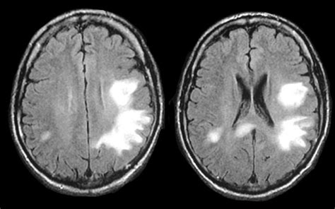 Progressive Multifocal Leukoencephalopathy