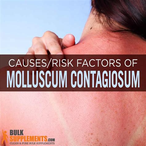 Molluscum Contagiosum In Adults