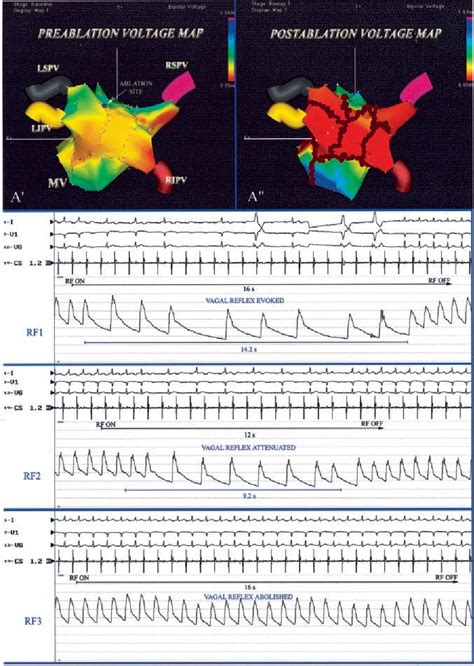 Paroxysmal Atrial Fibrillation Semantic Scholar