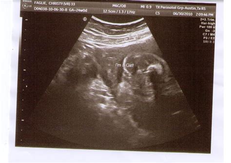 One Day At A Time: Baby Girl ultrasound 24 weeks