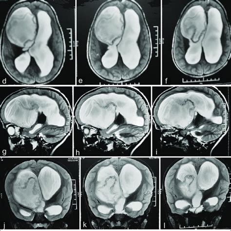 A C T1 Mri Axial Image Sequences Showing Hypointense Intraventricular Download Scientific