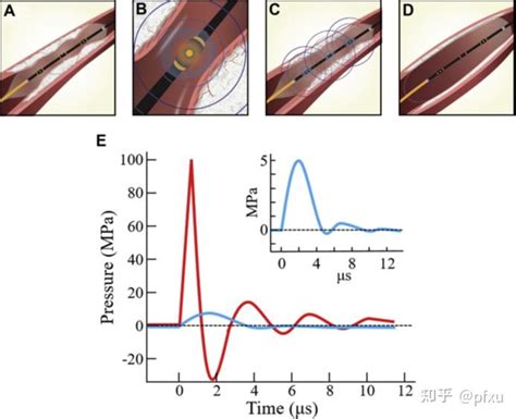 血管内冲击波碎石的一些原则 知乎