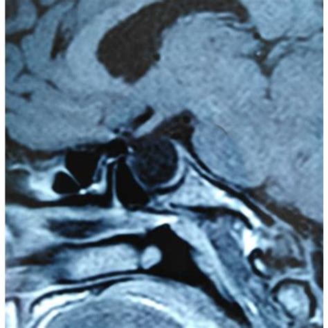 Sagittal Spin Echo T1 Weighted Image Showing The Macro Adenoma