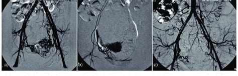 Bilateral Uterine Angiography Before And After Uterine Artery