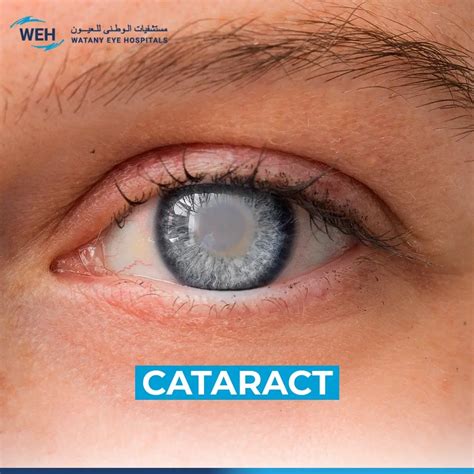 Cataracts Symptoms And Treatment