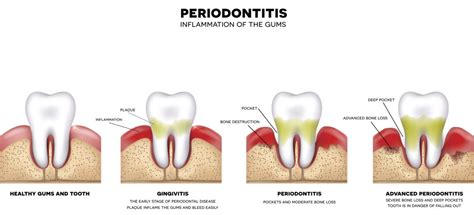 What To Do If Dog Has Bleeding Gums