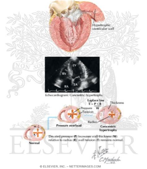 Left Ventricular Hypertrophy