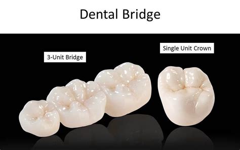 Porcelain Bridge | Westwood Family Dental