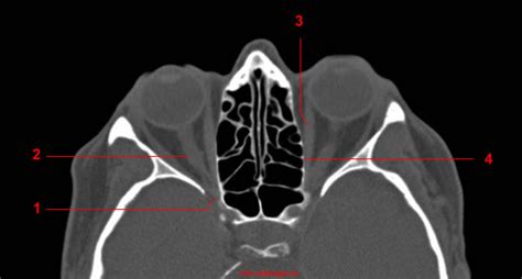 Ct Of The Orbit Anatomy W Radiology