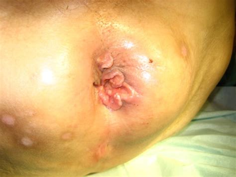 Squamous Cell Carcinoma Of The Anus Telegraph