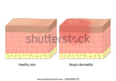 Atopic Dermatitis On Skin Over 1 394 Royalty Free Licensable Stock