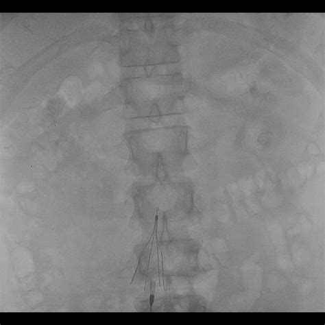 Inferior Vena Cava Filter Placement Procedure in Hyderabad