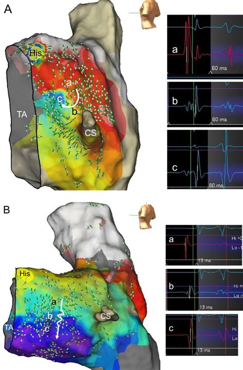 Activation Pattern Within Kochs Triangle During Sinus Rhythm In Patients With And Without