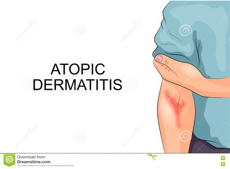 Dermatitis Atopic Eczema Close Up Of Cross Section Of Human Skin With