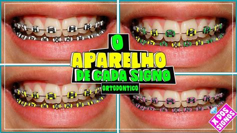 Cores De Aparelho Para Morenas - Cores De Aparelho Ortodontista Para Que Servem As Borrachinhas Dos