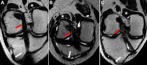 Ideal Combination Of Anatomic Tibial And Femoral Tunnel Positions For