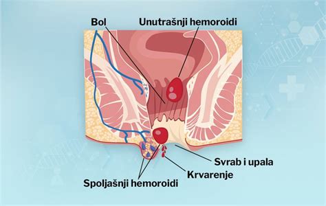 Hemoroidi Nastaju Na Vi E Na Ina A Naj E I Je Naprezanje Radi