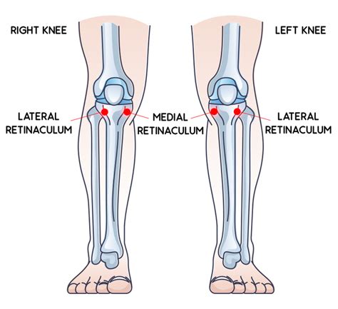 Donjoy Oa Reaction Knee Brace R Mediall Lateral Think Sport