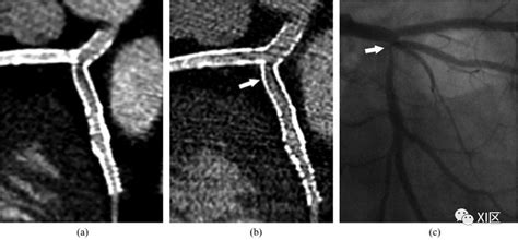 冠脉cta的图像质量：如何应对挑战？冠状动脉探测器图像算法 健康界