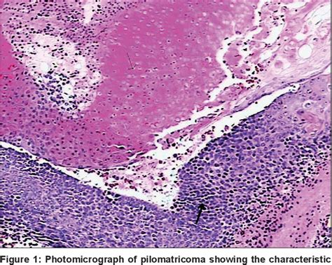 Figure 1 From PILOMATRICOMA AS A DIAGNOSTIC PITFALL IN CLINICAL