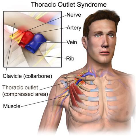 Thoracic Outlet Syndrome Tos Heres What You Need To Know