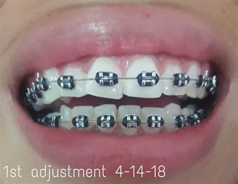 Black Colored Braces For Teeth