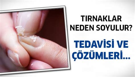 T Rnak Soyulmas Neyin Belirtisi Z M Nedir