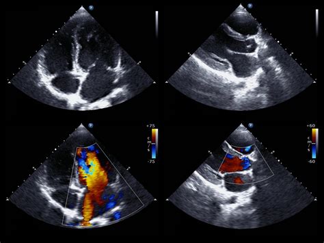 Patent Foramen Ovale Closure Reduces Stroke Risk In Patients With