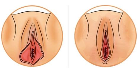 Labiaplasty Before And After Barbie