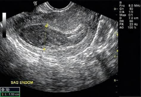 Figure 1 From Sonographic Detection Of Cornual Ectopic Pregnancy