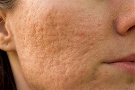 7 Formas De Tirar Cicatriz De Acne Do Rosto Tua Saúde