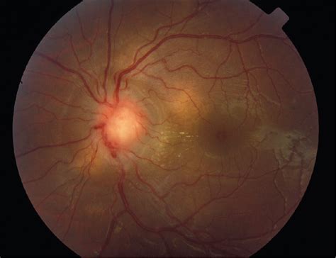 Figure From Anterior Segment Granuloma And Optic Nerve Involvement As