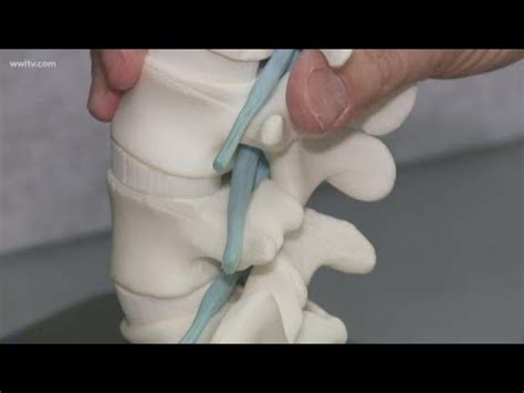 New Procedure Gives Instant Relief For Spinal Stenosis YouTube