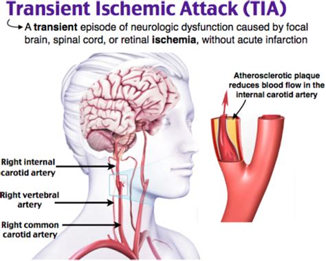 CVA- Pathophysiology Flashcards | Quizlet