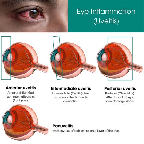 Uveitis Treatment Nyc Eye Inflammation Treatment Downtown Manhattan