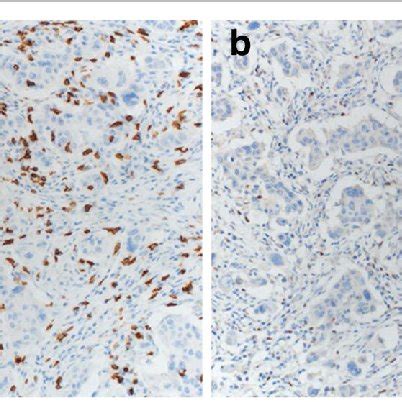 Tumor Cd And Foxp Expression As Assessed With Ihc In Breast Cancer