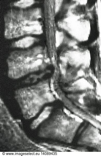 Herniated Disc L4 L5 Herniated Disc L4 L5 Mri Compressing Vertebra