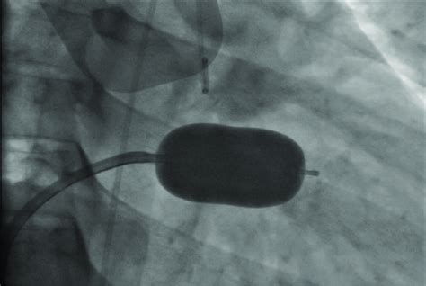 Percutaneous Transmitral Commissurotomy Shows Inflated Balloon Across