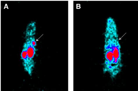 Pet Coronal Images Of Male Nude Mice Bearing Subcutaneous Lncap A And