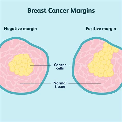 Dr Saam Touranis Blogs On Breast Cancer Basics — Cutting Edge Specialists